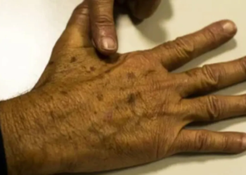 Mutirão para prevenção ao câncer de pele acontece em Salvador